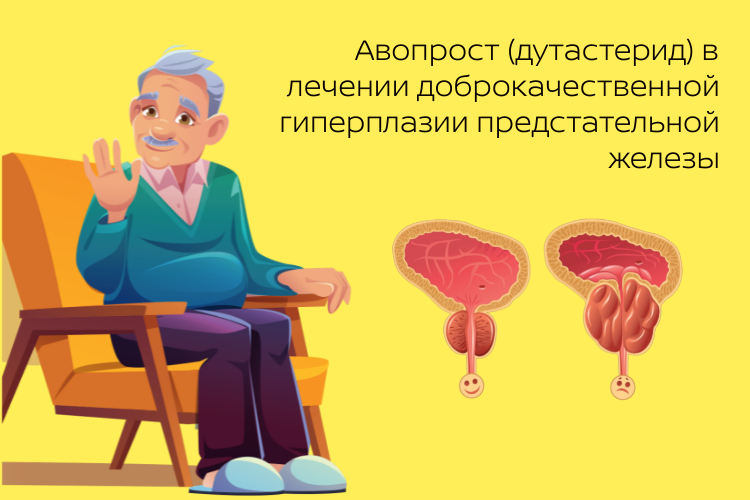Авопрост (дутастерид) в лечении доброкачественной гиперплазии предстательной железы